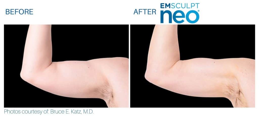 emsculpt neo Triceps treatment Middleboro, MA