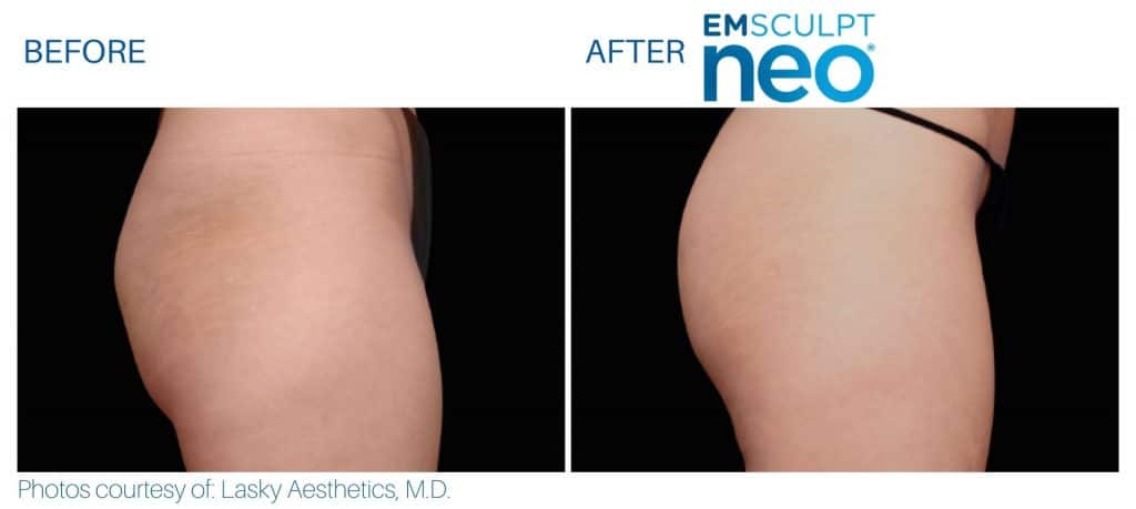 emsculpt neo Buttocks treatment JuliaEdelman MD