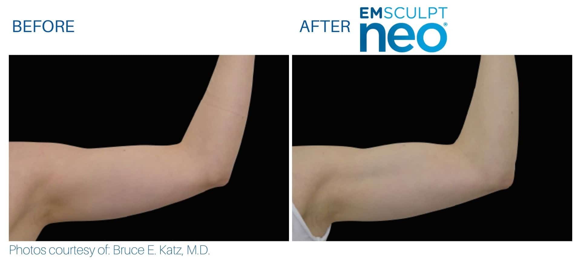Emsculpt NEO for Arms Contour + Strengthen Sexy Arms