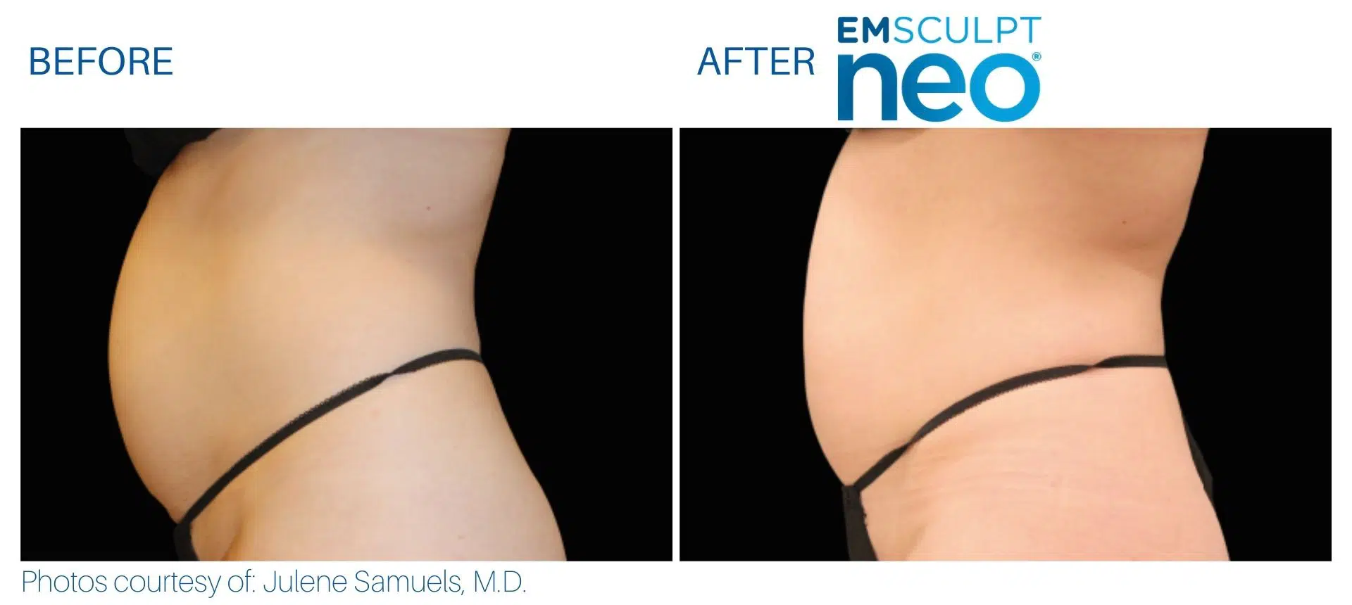 emsculpt neo abdomen women at Middleboro, MA