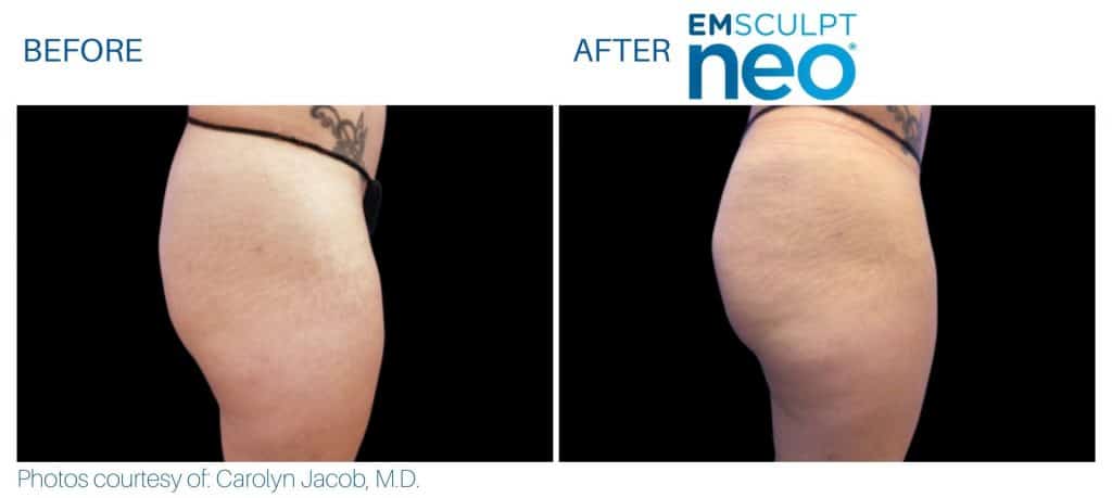 emsculpt neo Buttocks treatment at Middleboro, MA