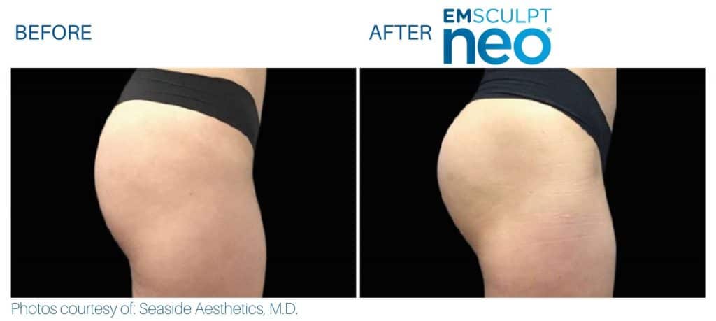 emsculpt neo Buttocks women treatment Middleboro, MA