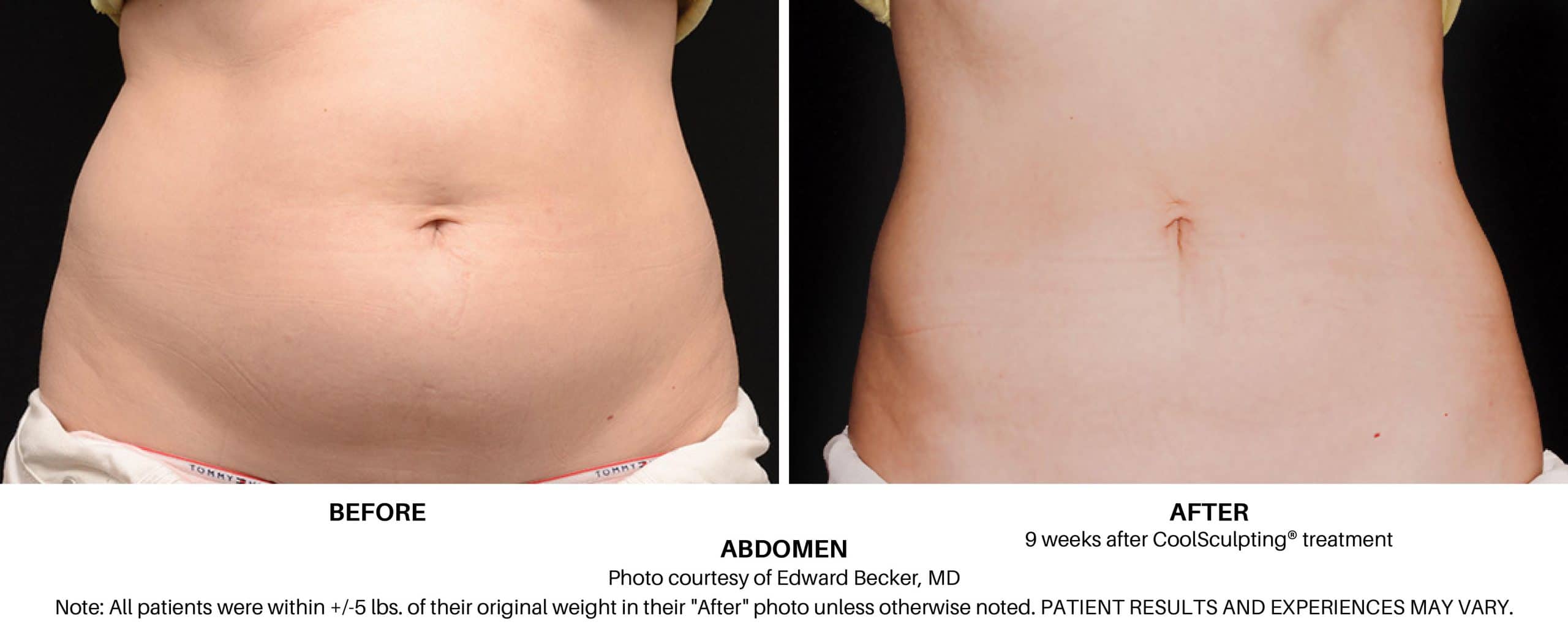 CoolSculpting® Elite Before & After Photos Patient 105, Boston, MA