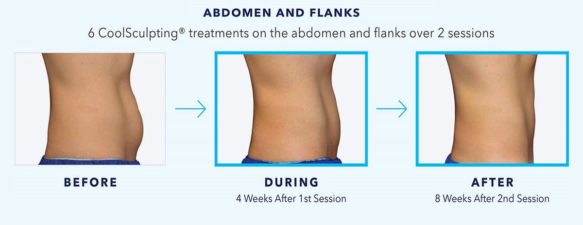 coolsculpting-before-and-after-abdomen-and-flanks-2