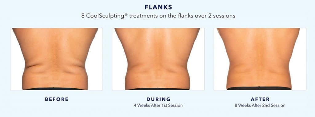 coolsculpting-before-and-after-abdomen-and-flanks-3