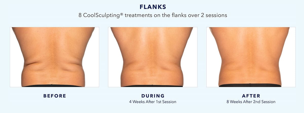 coolsculpting-before-and-after-abdomen-and-flanks-3