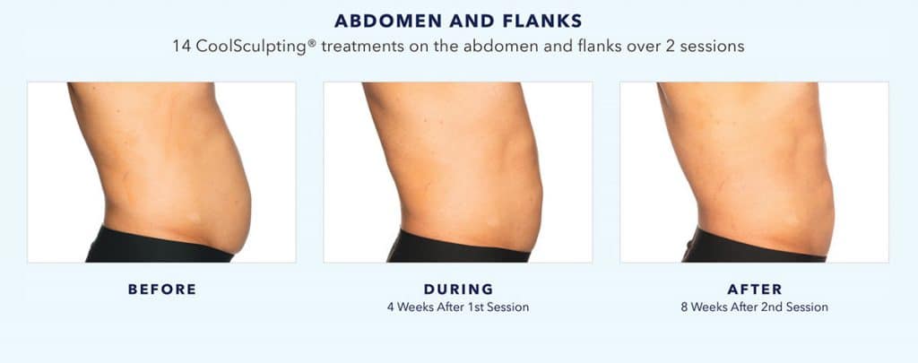 coolsculpting-before-and-after-abdomen-and-flanks-4