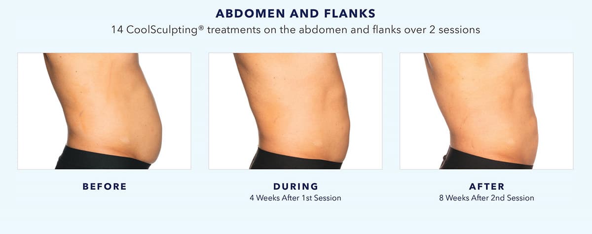 coolsculpting-before-and-after-abdomen-and-flanks-4