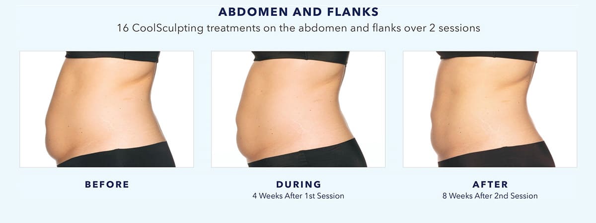 coolsculpting-before-and-after-abdomen-and-flanks