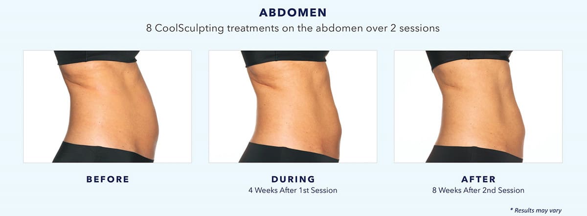 coolsculpting-before-and-after-abdomen