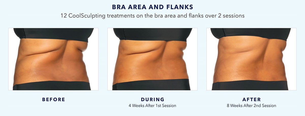 coolsculpting-before-and-after-bra-area-and-flanks