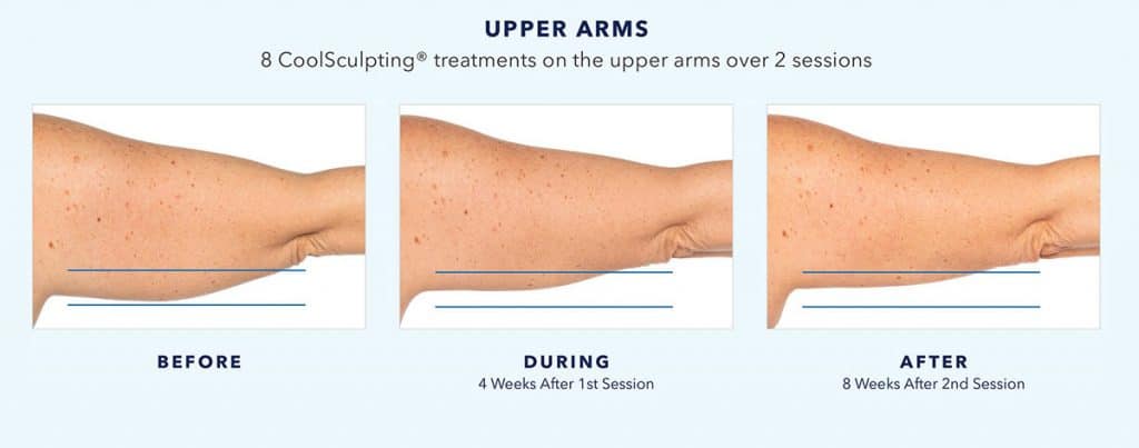 coolsculpting-before-and-after-upper-arms