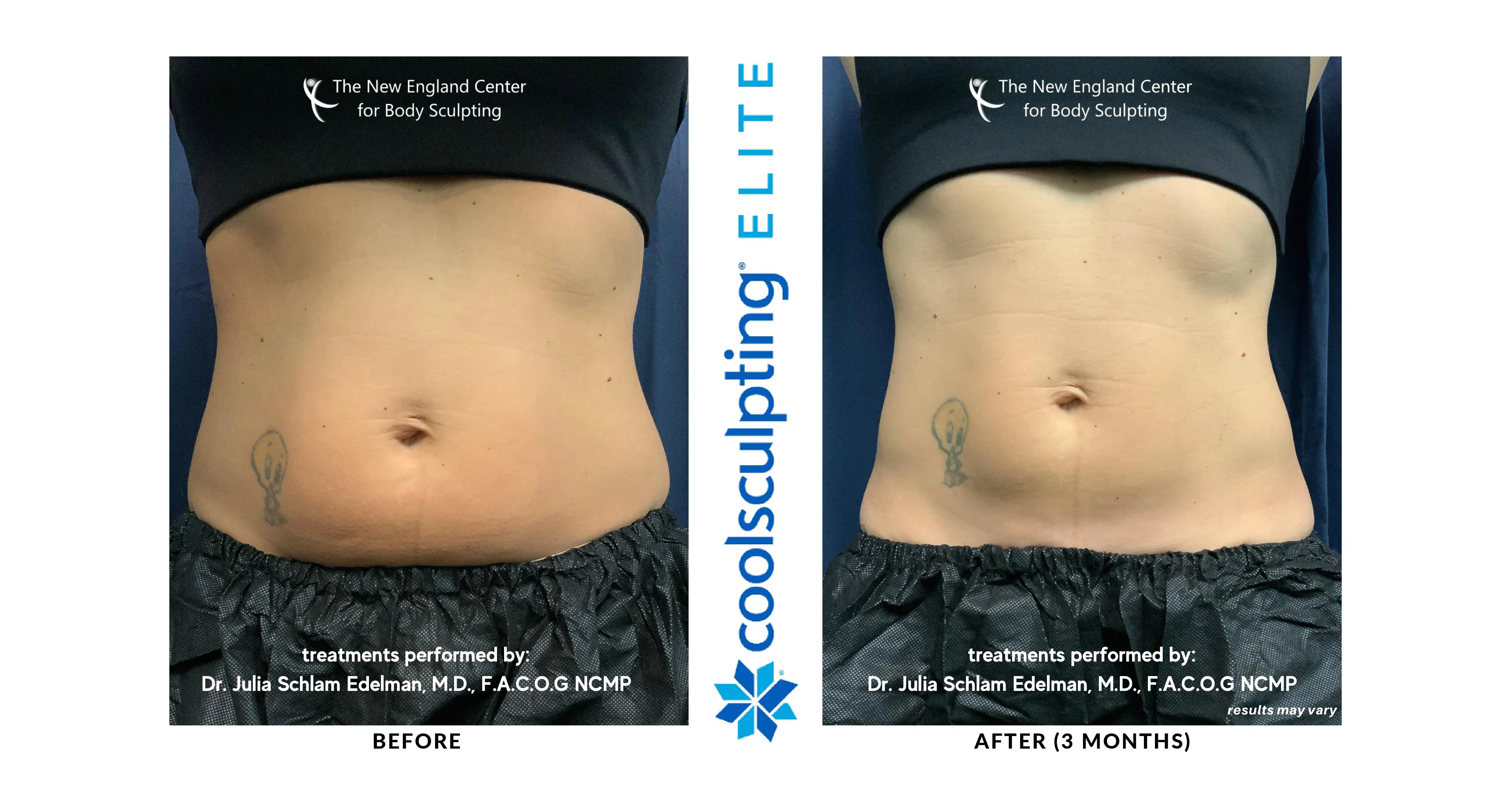CoolSculpting versus Liposuction: Which One Is Best for You?