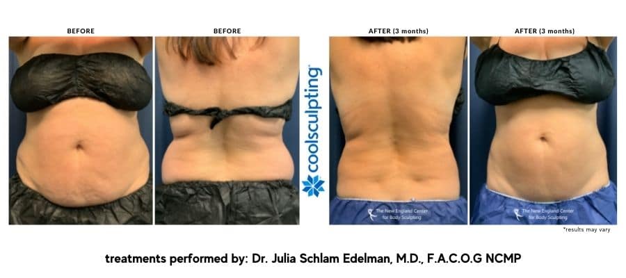 coolsculpting-before-and-after-dr.-edelman-desktop
