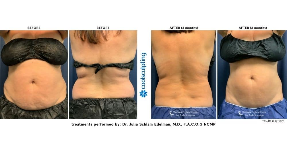 coolsculpting-before-and-after-dr.-edelman-mobile