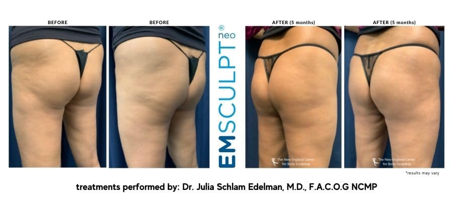 emsculpt-before-and-after-dr.-edelman-desktop emsculpt-before-and-after-dr.-edelman-desktop