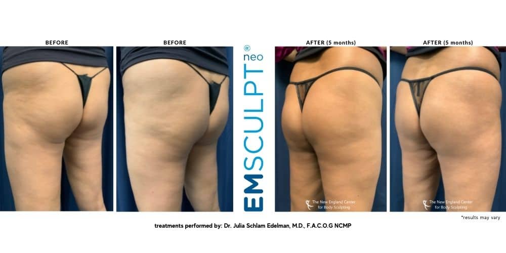 emsculpt-before-and-after-dr.-edelman-mobile emsculpt-before-and-after-dr.-edelman-mobile