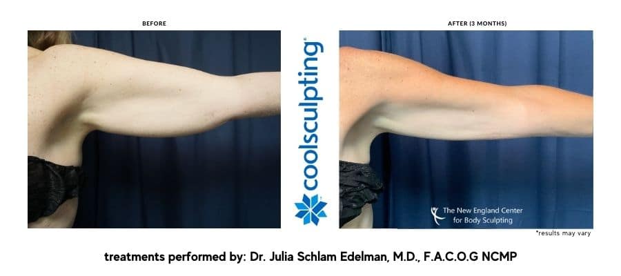 coolsculpting-arms-before-and-after-dr.-edelman-desktop coolsculpting-arms-before-and-after-dr.-edelman-desktop