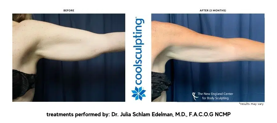 CoolSculpting Elite Before and After  New Treatment + Better Results —  Emerson Medical