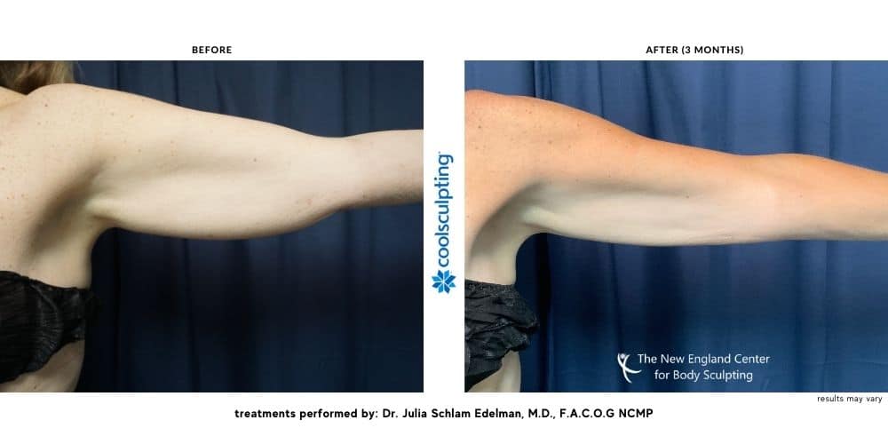 Coolsculpting on arms before and after.