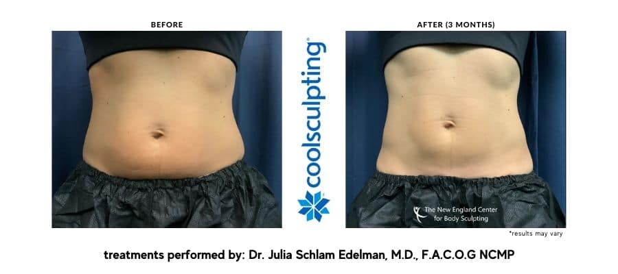 Abdomen before and after Coolsculpting in New England.