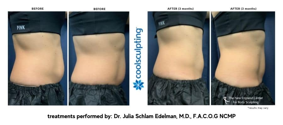 tattoo-edit-coolsculpting-before-and-after-dr.-edelman-desktop-2-1 Abdomen before and after Coolsculpting in New England.