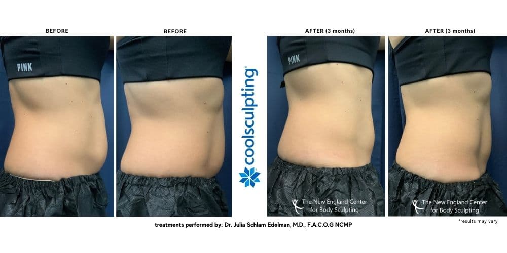 Abdomen before and after coolsculpting treatment.