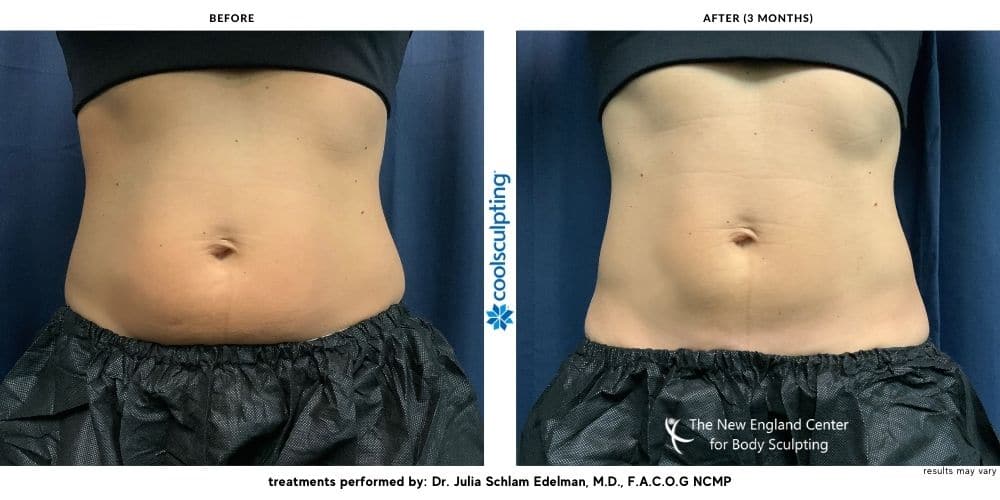 Abdomen before and after CoolSculpting.