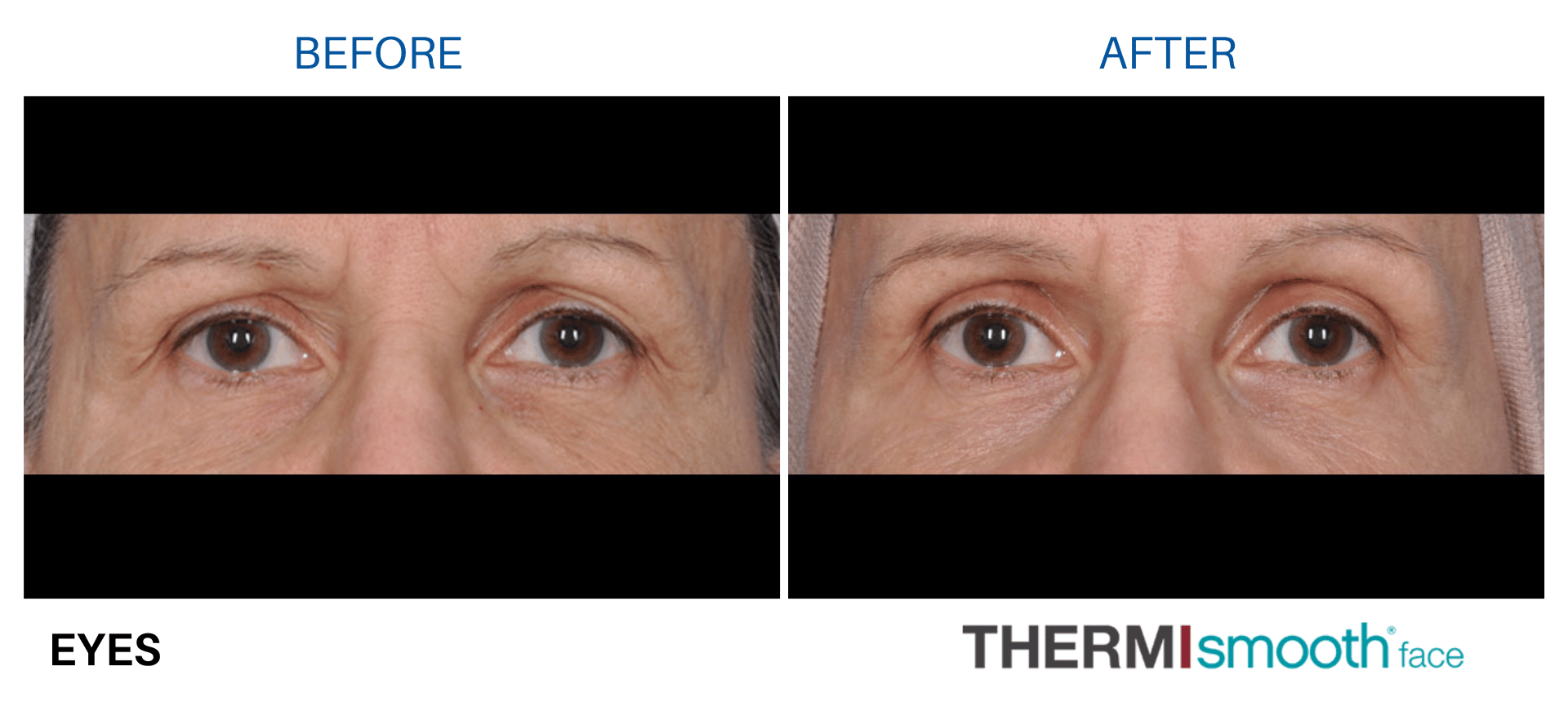 thermismooth-before-and-after-1 thermismooth-before-and-after-1
