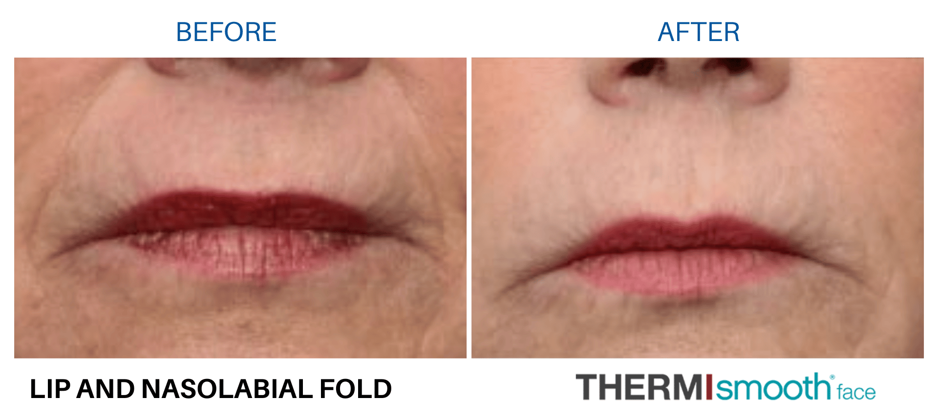 thermismooth-before-and-after-3 thermismooth-before-and-after-3