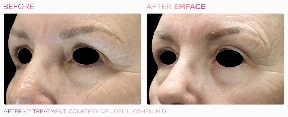 emface_browlift_before_and_after emface_browlift_before_and_after