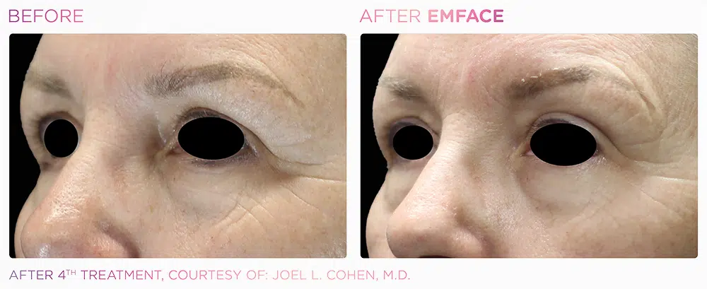 emface_browlift_before_and_after