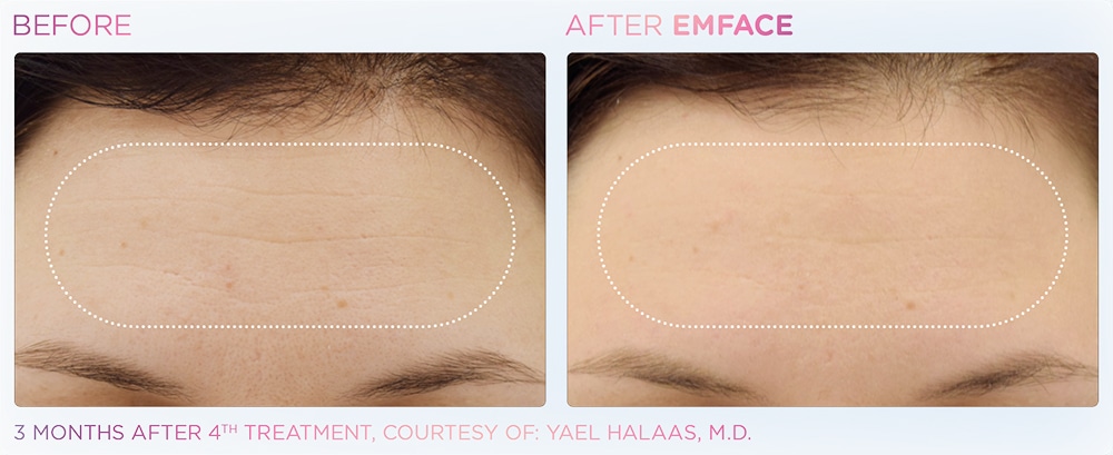 emface_forehead_before_and_after emface_forehead_before_and_after