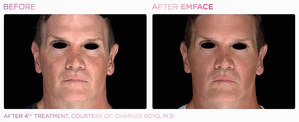 emface_full_face_before_and_after emface_full_face_before_and_after