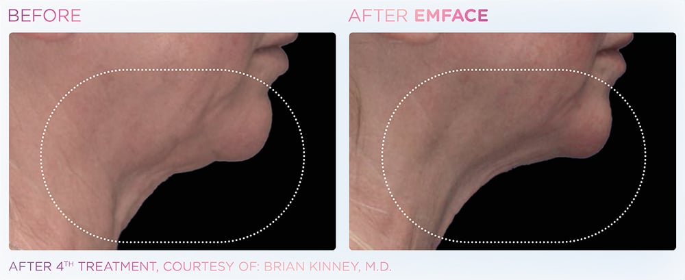 emface_neck_before_and_after