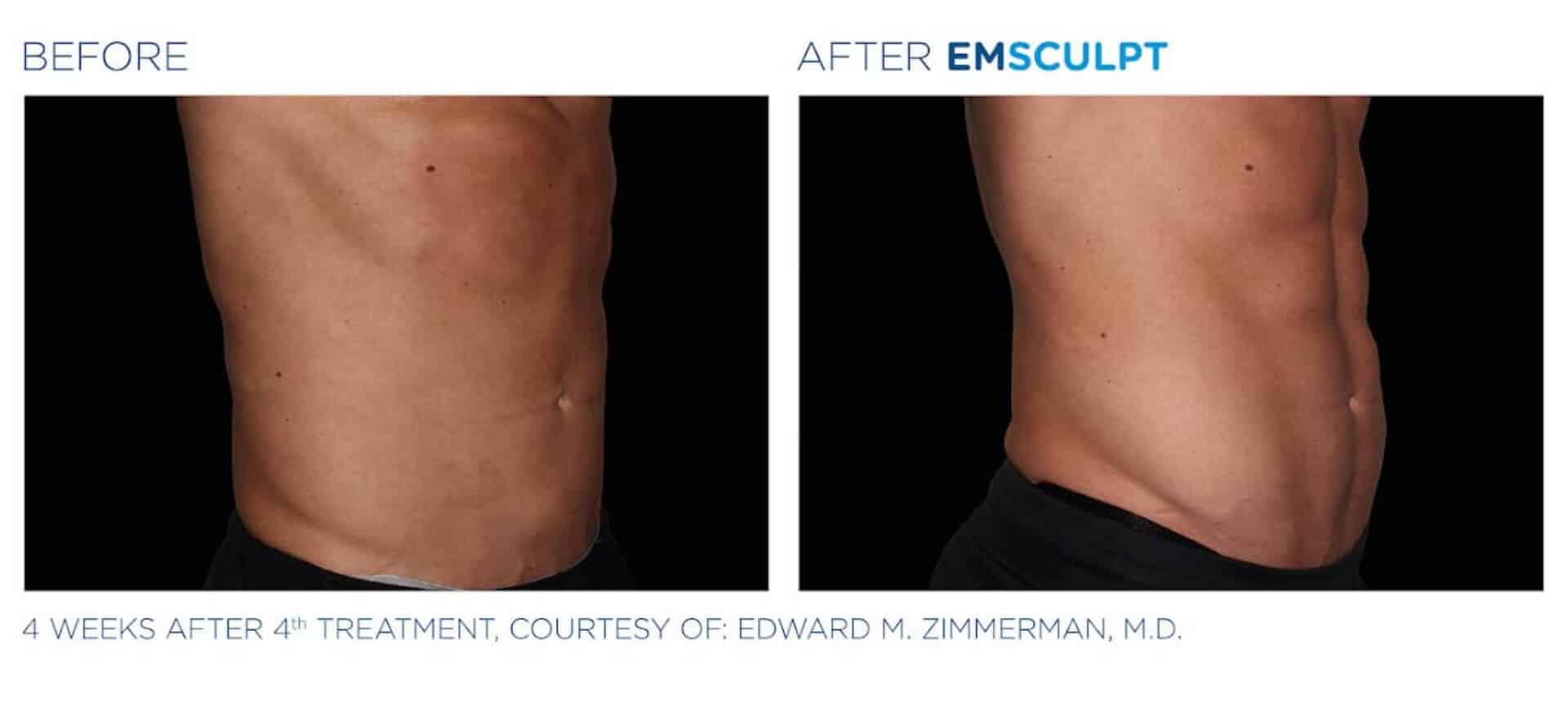emsculpt-before-and-after-1