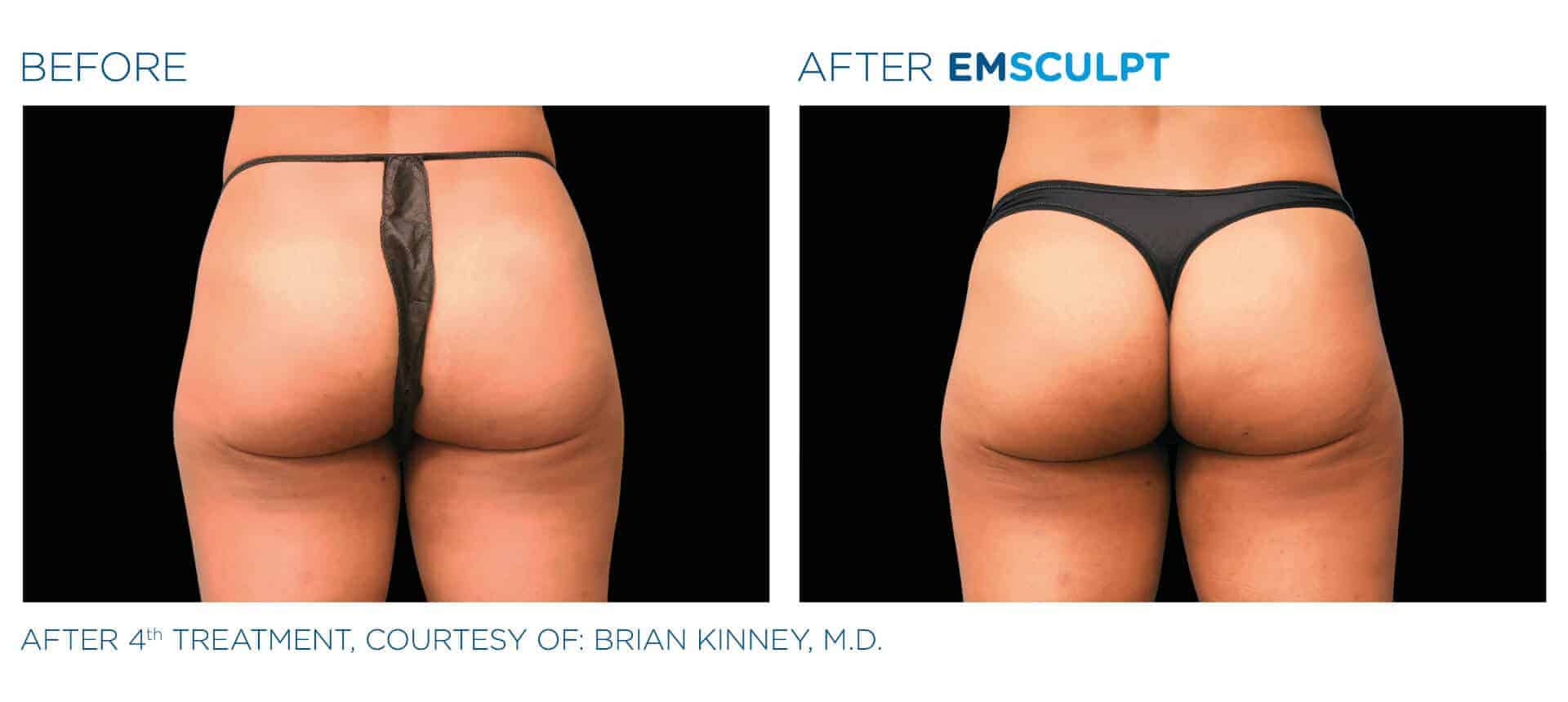 emsculpt nonsurgical butt lift before and after