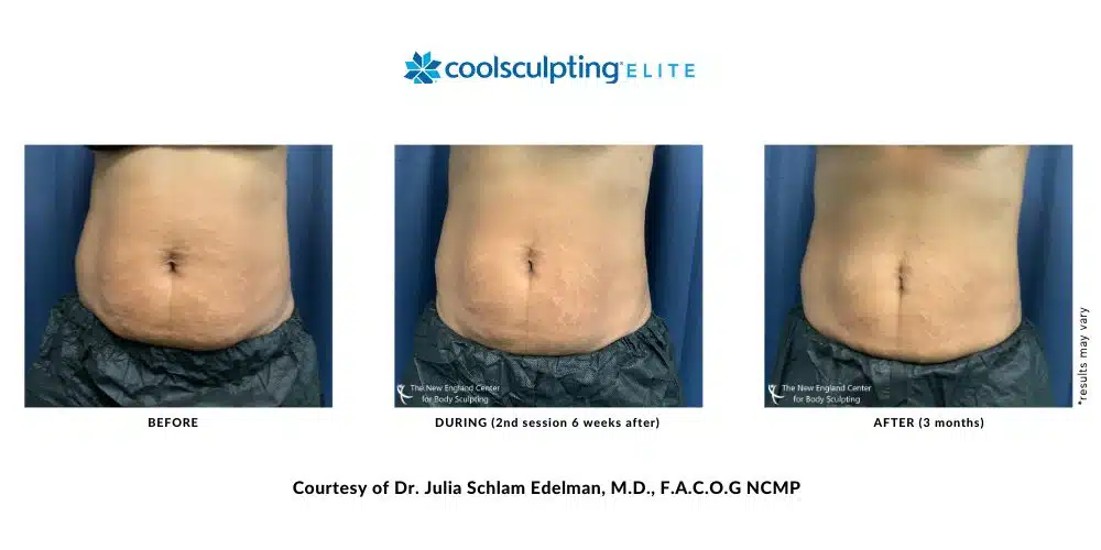 julia-edelman-coolsculpting-elite-before-and-after-image-mobile