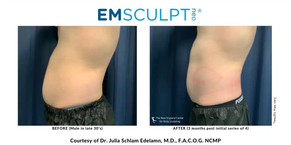 Differences between CoolSculpting and Emsculpt – What is Best for Me? -  Sculpt MD