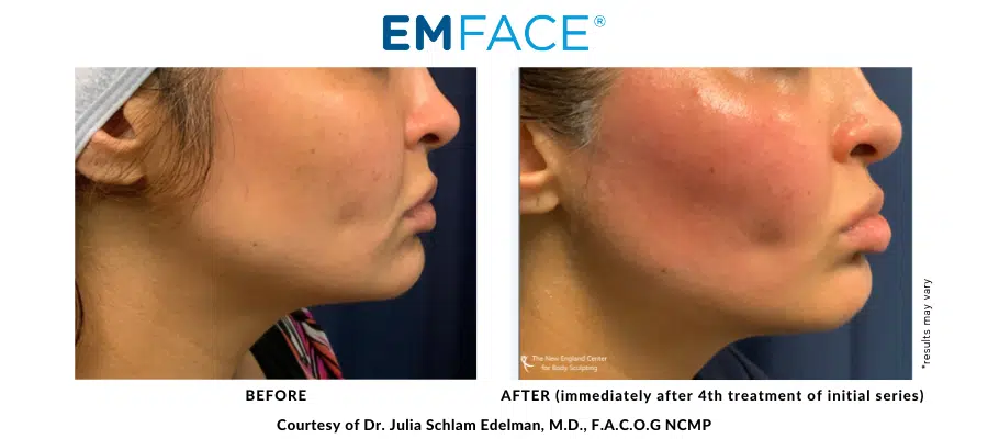 julia-edelman-emface-before-and-after-1