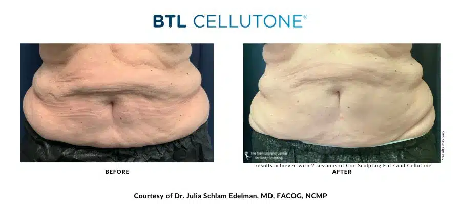 Actual CoolSculpting Elite and Cellutone before and after treatment images by Dr. Julia Edelman