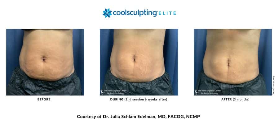 coolsculpting-elite-before-and-after-dr.-edelman-desktop-1 Actual before and after image of a CoolSculpting Elite abdomen area treatment by Dr. Edelman in Middleboro, MA