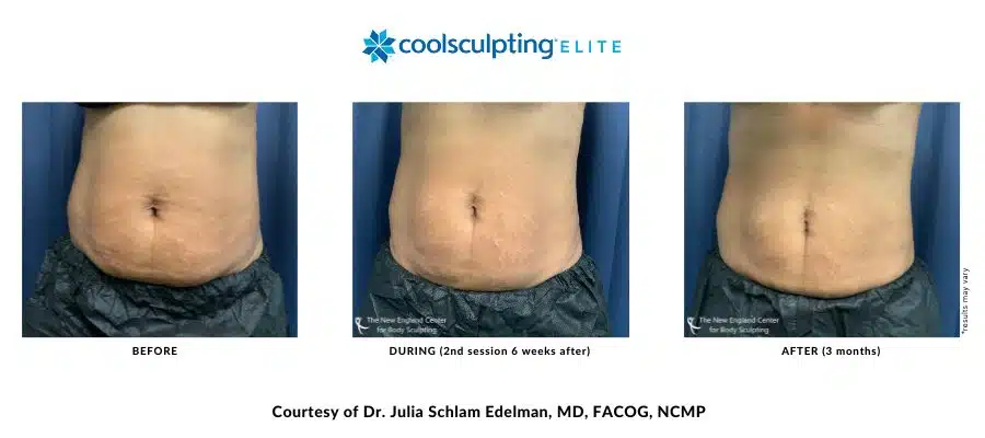 Actual before and after image of a CoolSculpting Elite abdomen area treatment by Dr. Edelman in Middleboro, MA