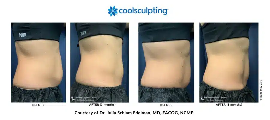 Actual before and after image of a CoolSculpting Elite treatment on the abdomen area by Dr. Julia Edelman