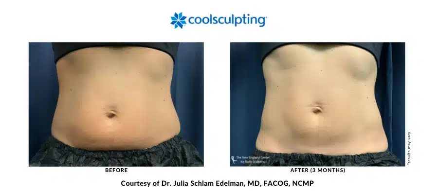 The abdomen area was treated with CoolSculpting Elite by Dr. Edelman in Middleboro, MA.