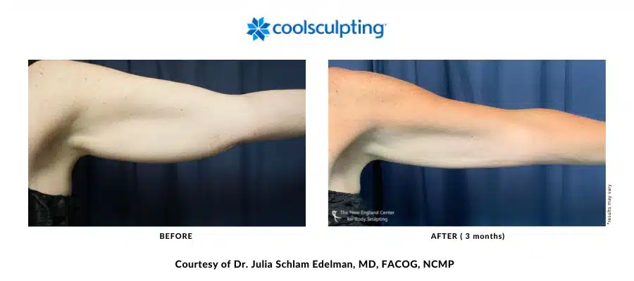 Before and after pictures of the CoolSculpting Elite arm area treatment in Middleboro, Massachusetts