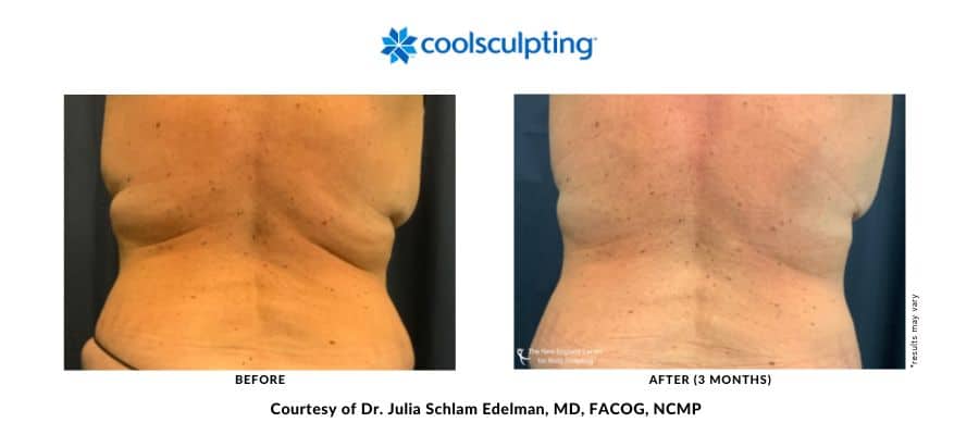 coolsculpting-elite-before-and-after-dr.-edelman-desktop-5 CoolSculpting Elite back bra before and after treatment with Dr. Julia Edelman in Middleboro, MA