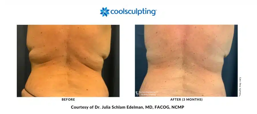 CoolSculpting Elite back bra before and after treatment with Dr. Julia Edelman in Middleboro, MA