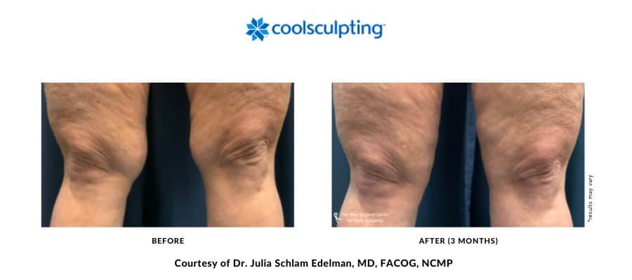coolsculpting-elite-before-and-after-dr.-edelman-desktop-6 Actual before and after image of a CoolSculpting Elite above-the-knee area treatment by Dr. Julia Edelman in Middleboro, MA
