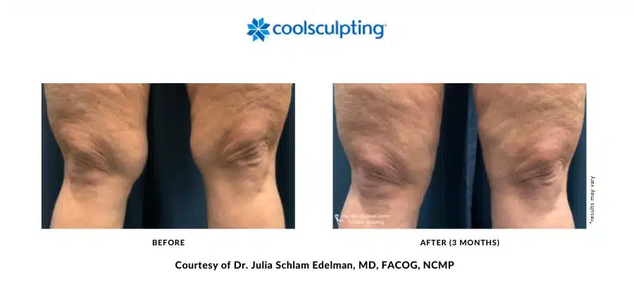 Actual before and after image of a CoolSculpting Elite above-the-knee area treatment by Dr. Julia Edelman in Middleboro, MA